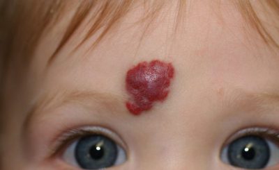 Опухоль у ребенка