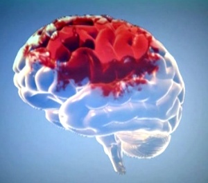 Геморрагический инсульт