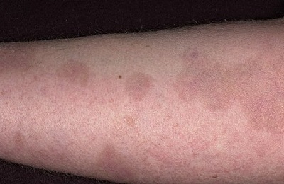 Гиперпигментация кожи