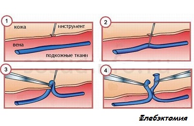 Флебэктомия