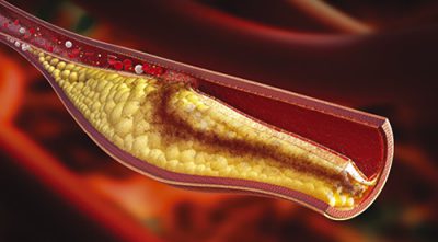 Холестерин в сосудах