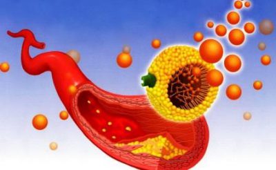 Отложения в сосудах