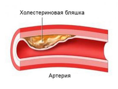 Отложение холестерина
