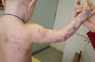 Ангиодисплазия