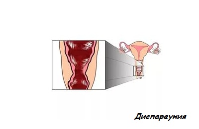 Диспареуния
