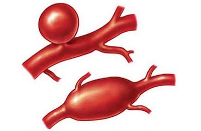 Болезнь сосудов