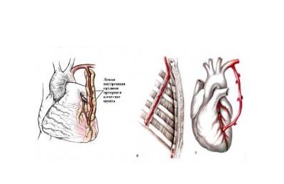 Установка сосуда