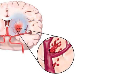 Поражение мозга