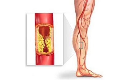 Отложения в сосудах