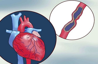 Сердечная стенокардия