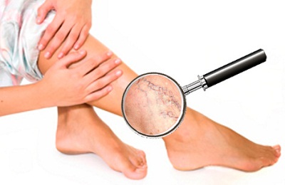 Варикозное расширение