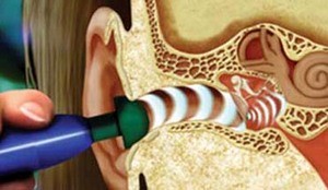 Лабиринтэктомия