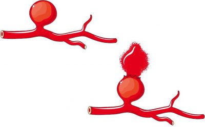 Разрыв сосуда