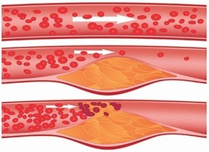 Наличие «бляшек» в сосудах