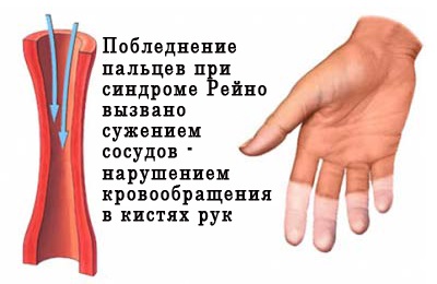 Синдром Рейно