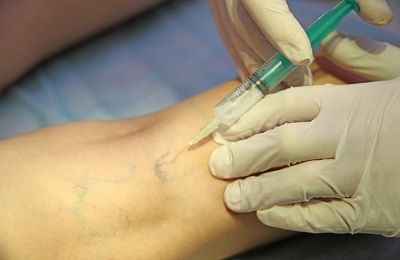 Лечение вен