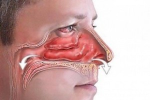 Осложения ОРВИ