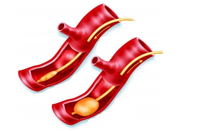 Непрямая тромбэктомия