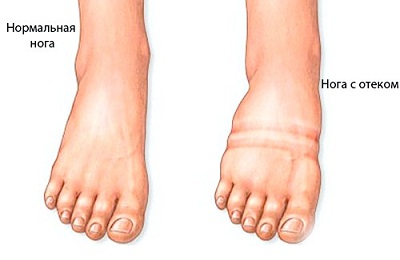 Отеки ног