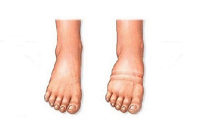 Отечность ног