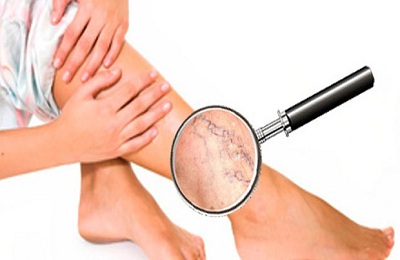 Поражение ног