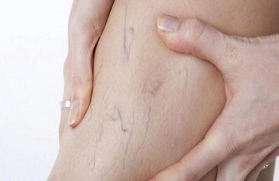 Ретикулярный варикоз