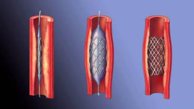 Операция на сосудах