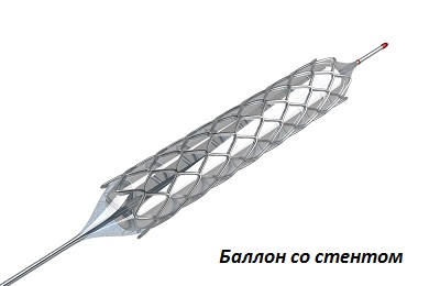 Баллон со стентом