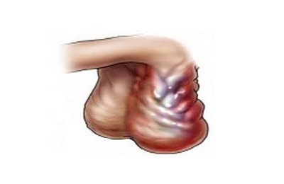 Заболевание мошонки