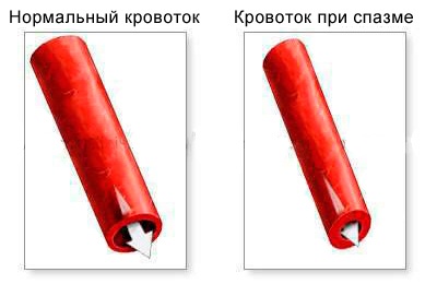 Сужение сосуда