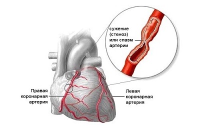 Стенокардия