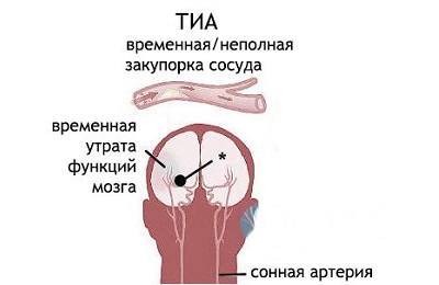ТИА