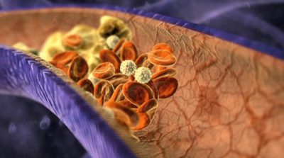 Тромбоз вен