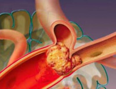 Закупорка сосуда