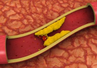 Тромб в вене