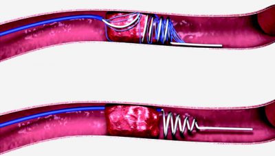 Очистка сосудов