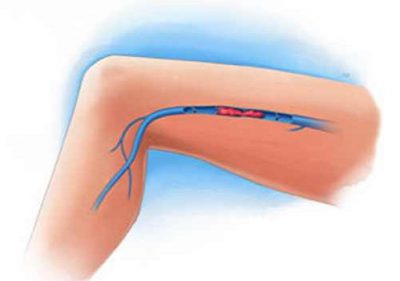 Тромбофлебит конечностей