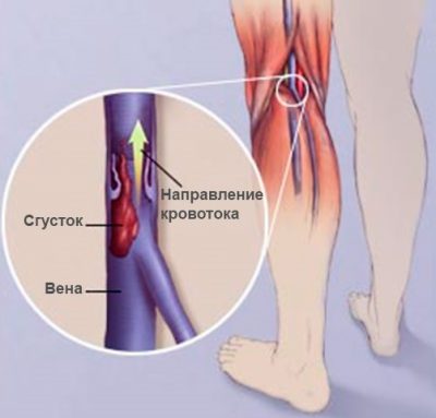 Тромбоз ног