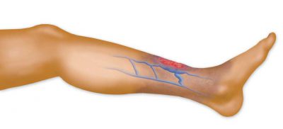 Тромбоз ног