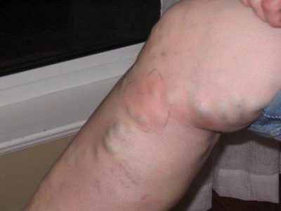 Тромбоз вен ног