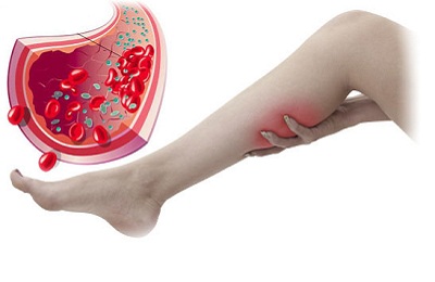 Поражение сосуда