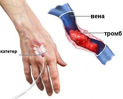 Причины тромбоза