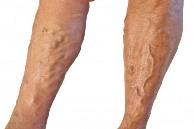 Шишки в венах