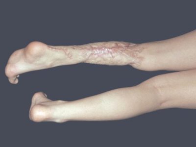 Закупорка вен