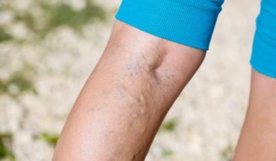 Тромбоз на ногах