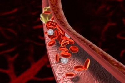 Тромб в вене