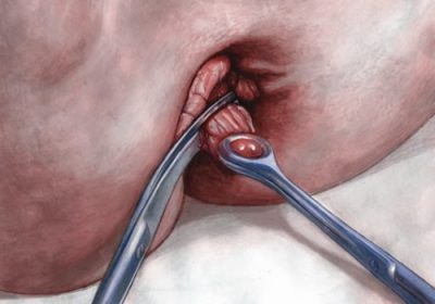 Оперативное вмешательство