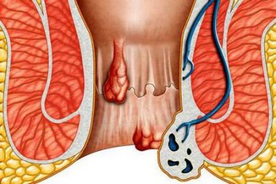 Воспаление