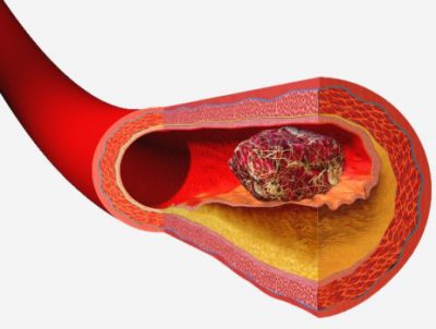 Сгусток в сосуде