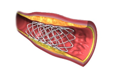 Установка стента